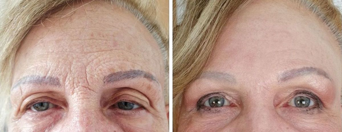 rimozione rughe frontali