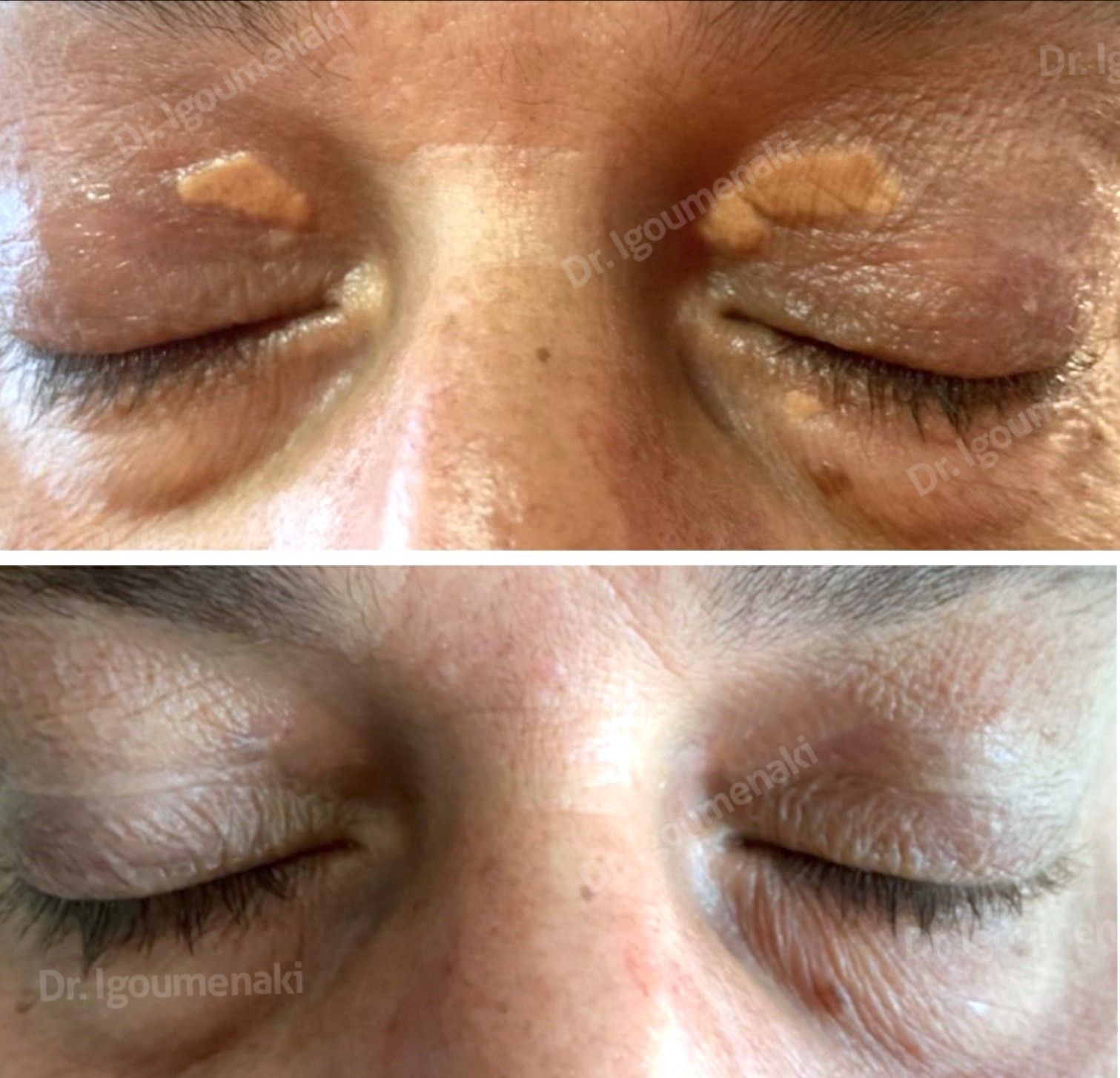 rimozione xantelasmi