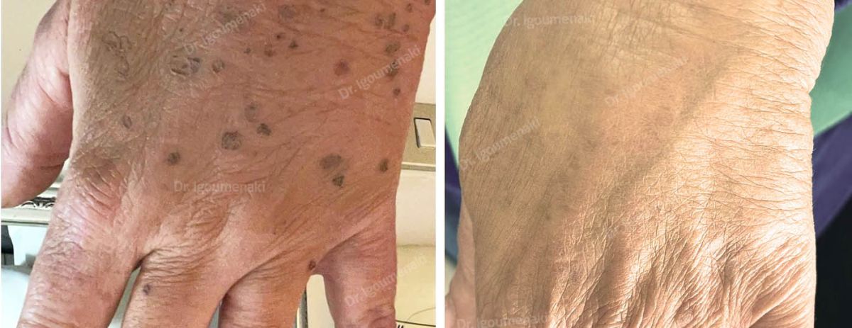 Rimozione macchie o lentigo