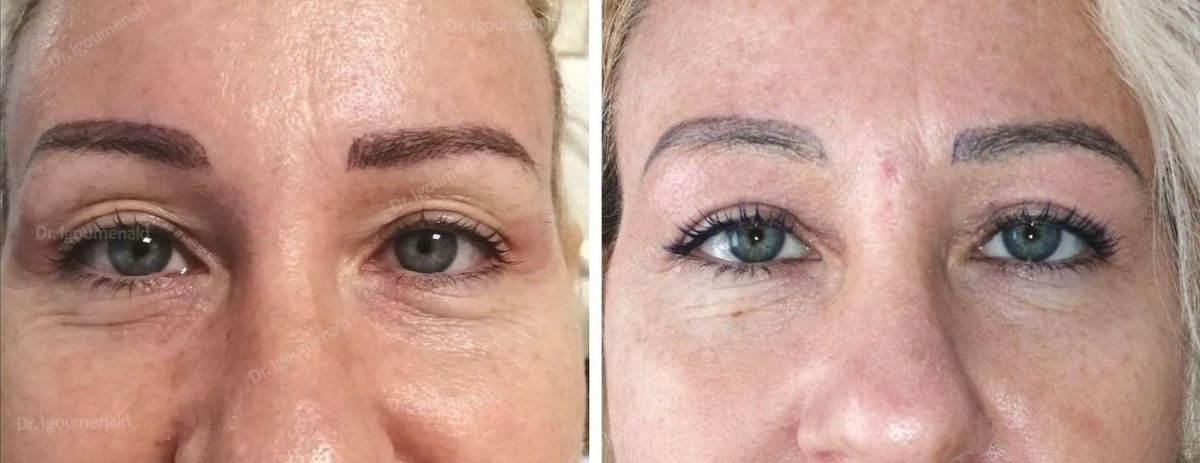 Blefaroplastica superiore non chirurgica