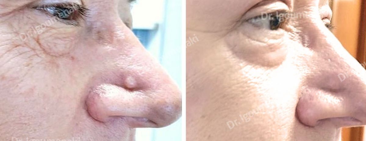 Rimozione Fibromi penduli