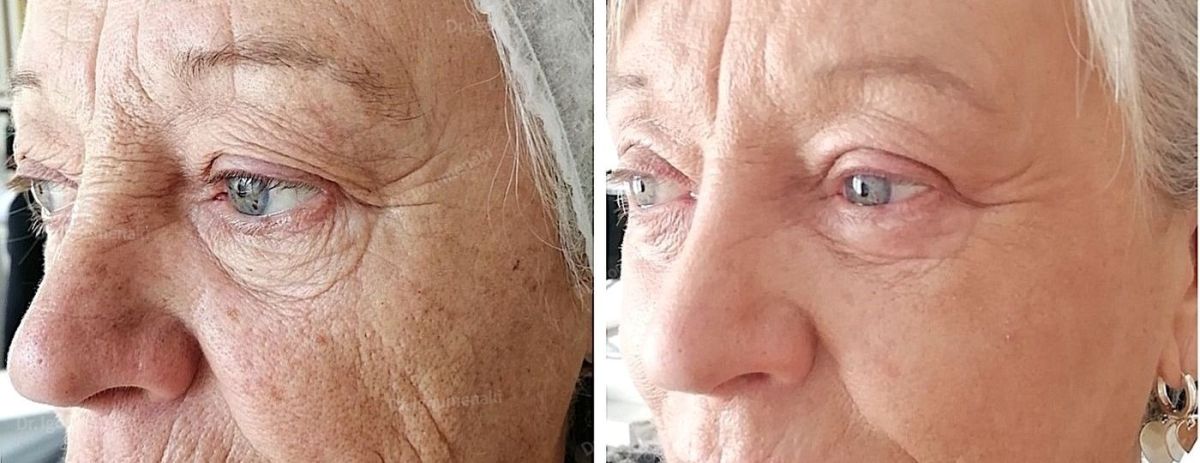 rimozione rughe del naso