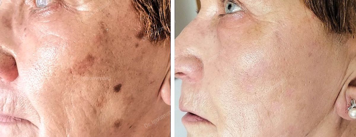 Rimozione macchie o lentigo