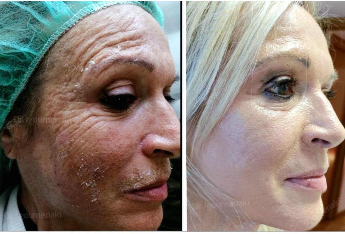 rimozione rughe dal volto