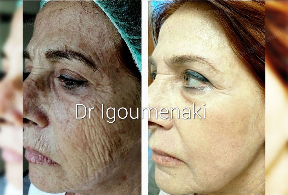 rimozione rughe dal volto