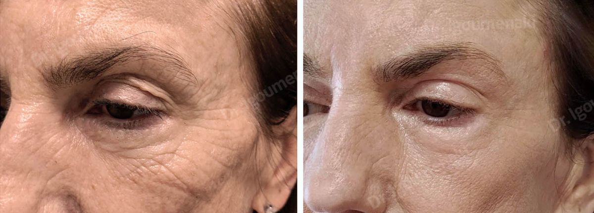 Blefaroplastica inferiore non chirurgica