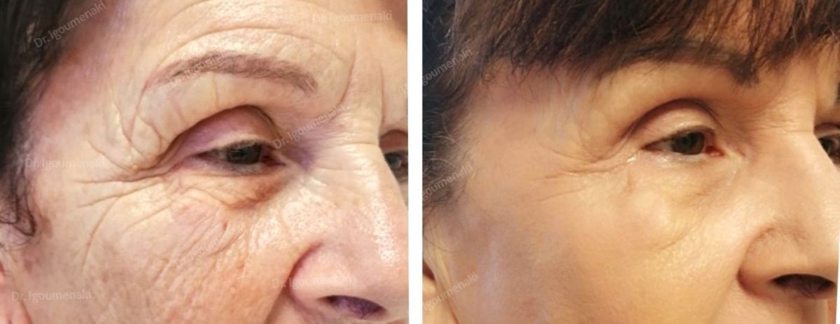 rimozione "zampe di gallina"