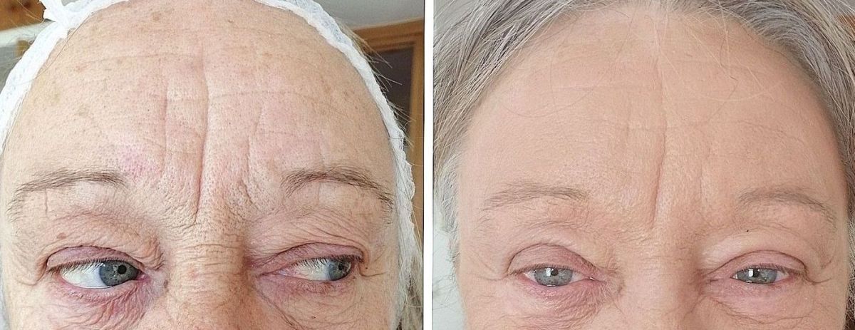 rimozione rughe frontali