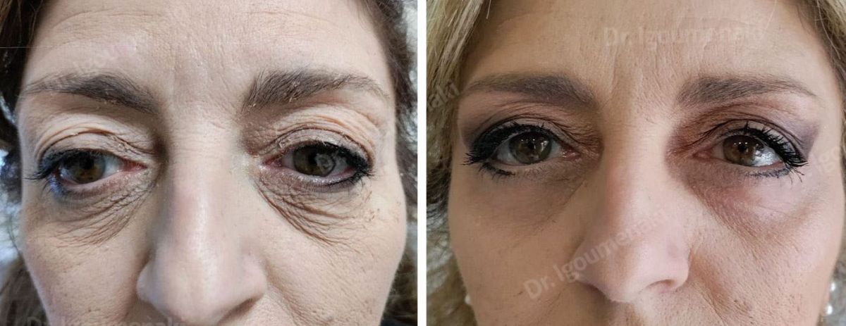 Blefaroplastica inferiore non chirurgica