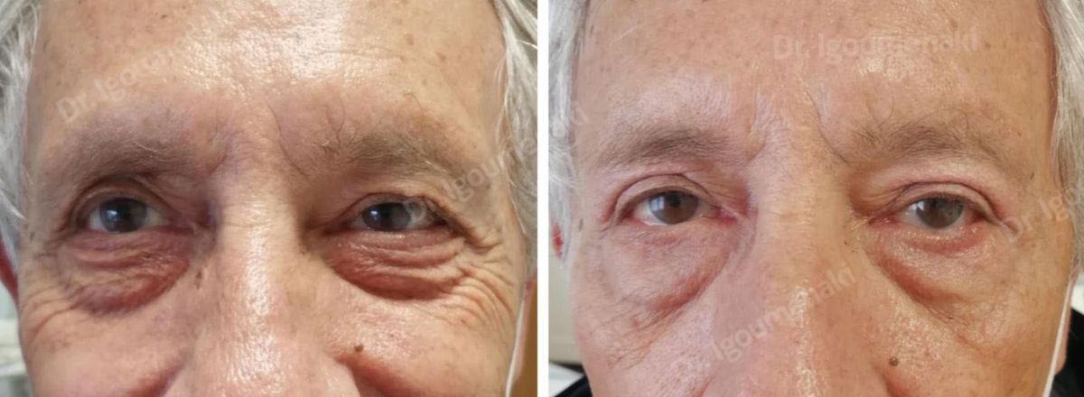 Blefaroplastica inferiore non chirurgica