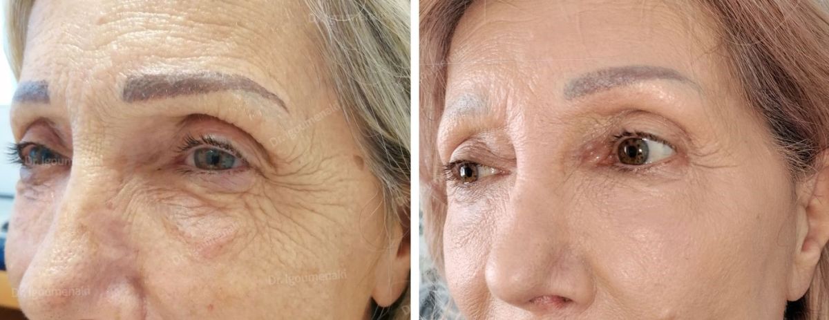 rimozione "zampe di gallina"