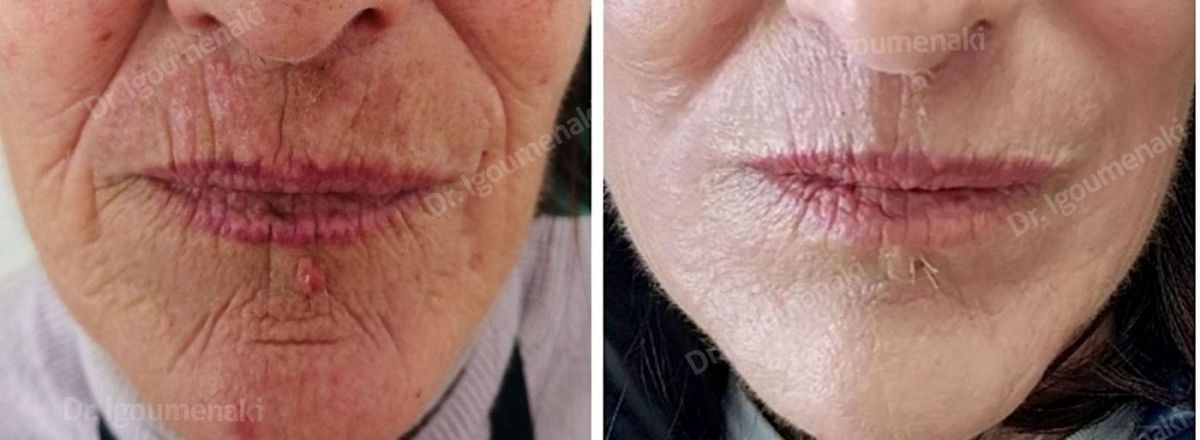 rimozione "codice a barre"