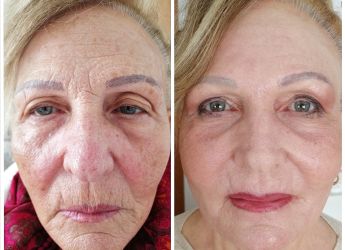 rimozione rughe frontali