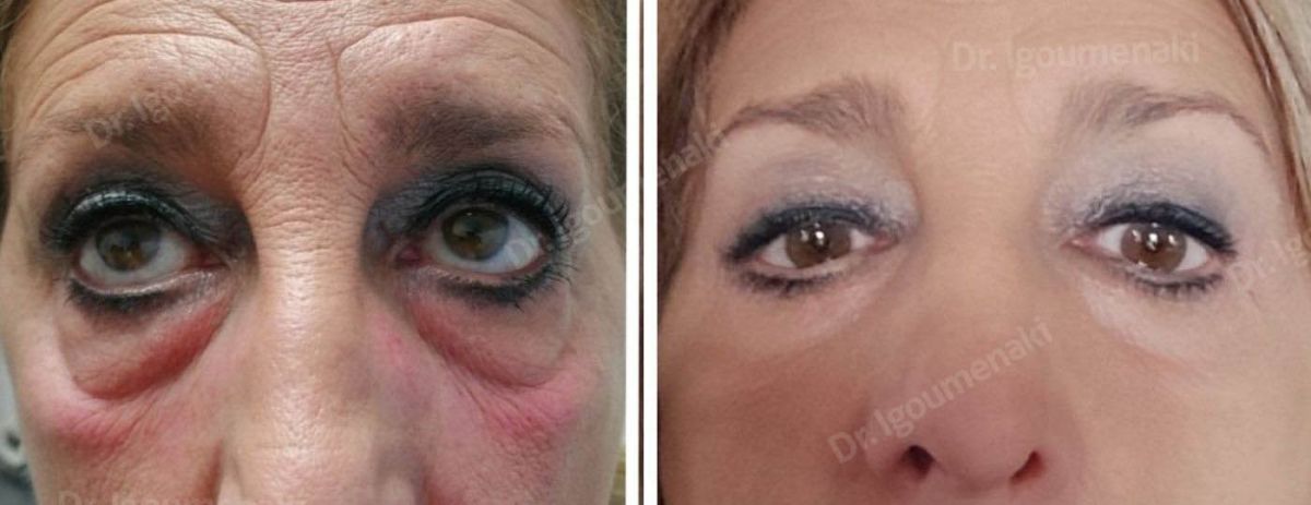 Blefaroplastica inferiore non chirurgica