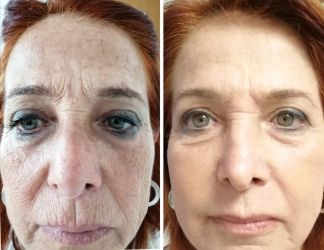 rimozione rughe frontali