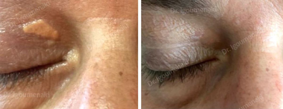 Rimozione xantelasmi