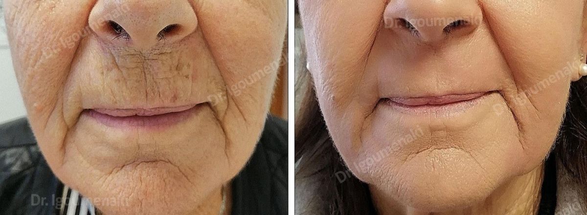 rimozione "codice a barre"