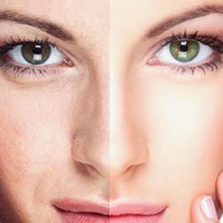 Blefaroplastica non chirurgica