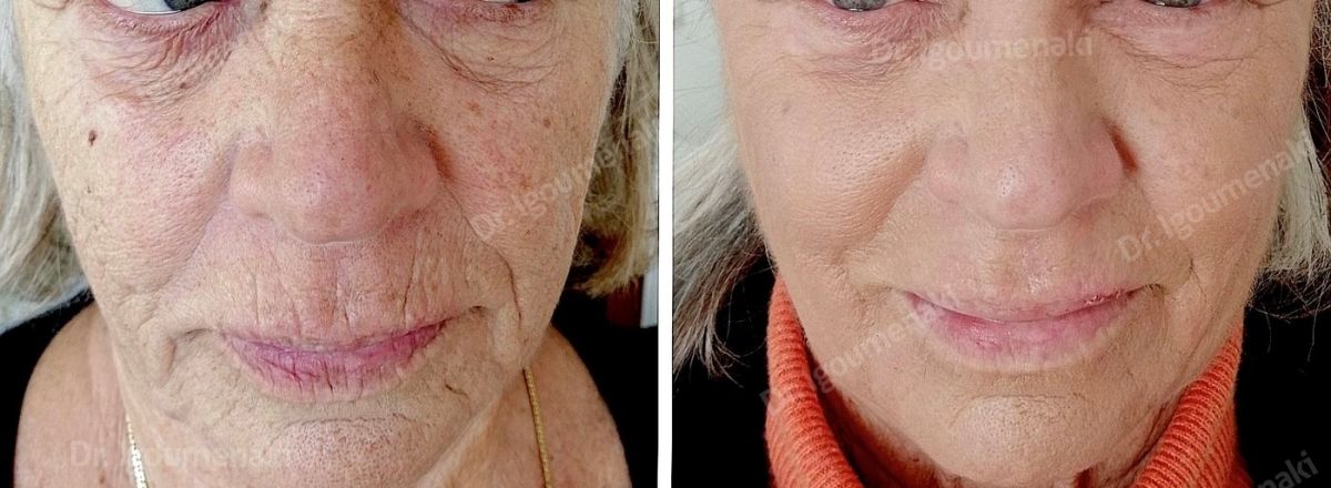 rimozione "codice a barre"