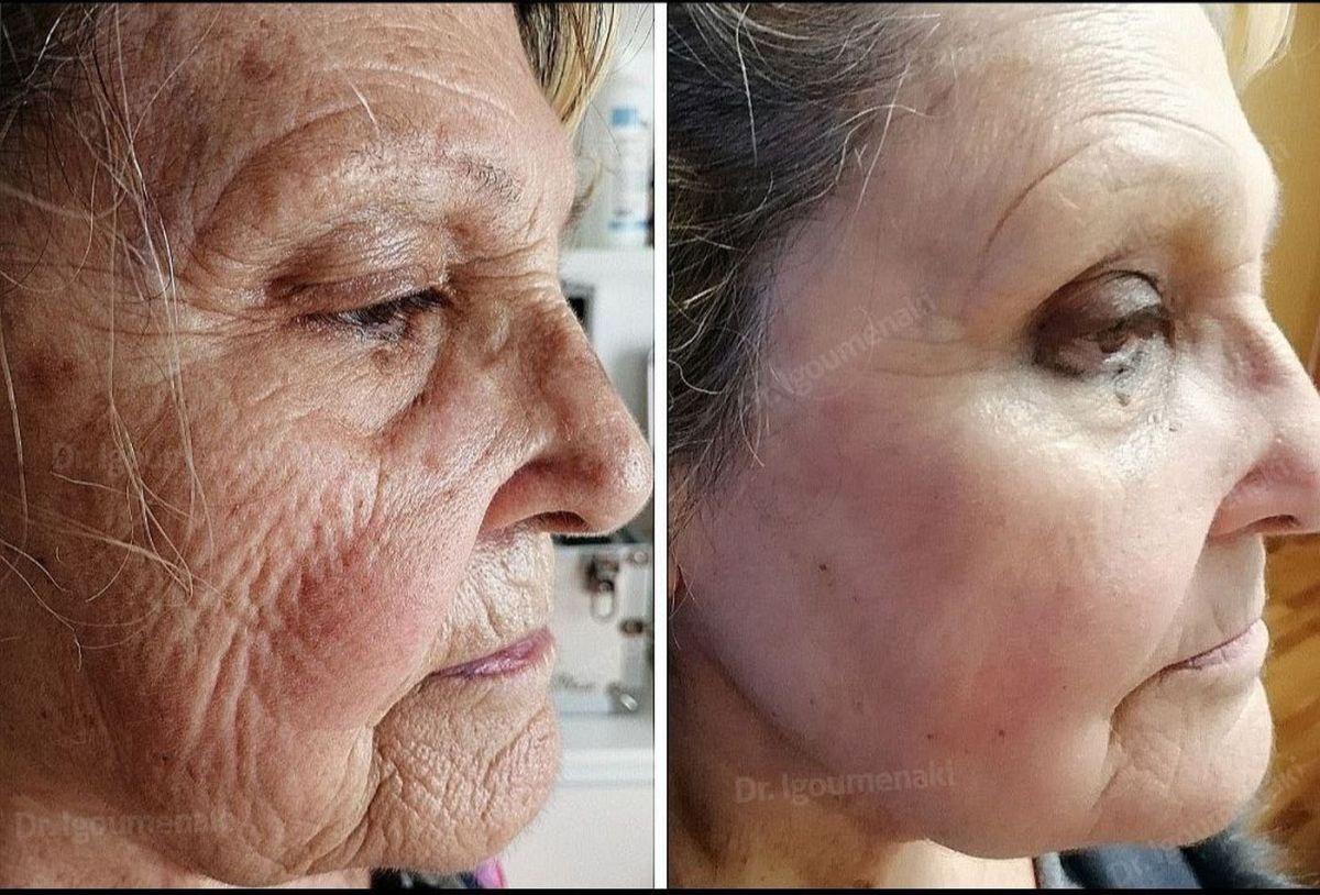 rimozione rughe dal volto