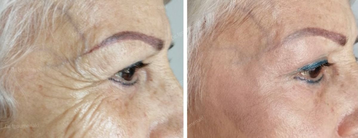 rimozione "zampe di gallina"