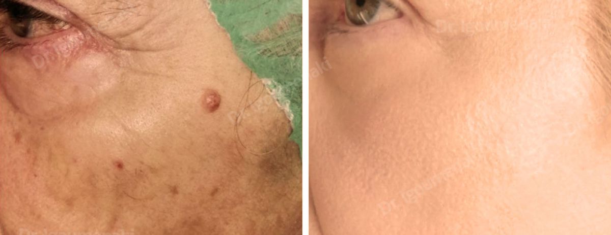 Rimozione Fibromi penduli