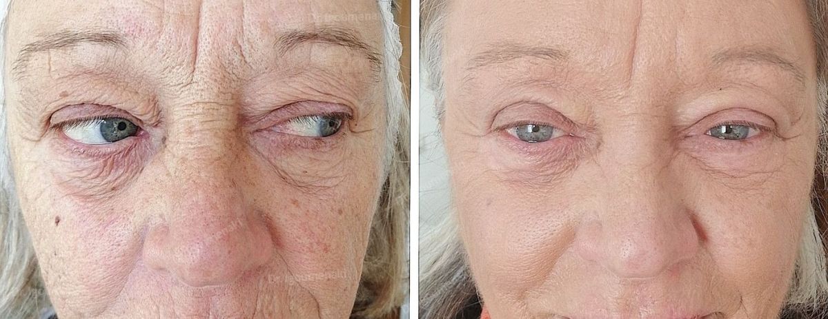 rimozione rughe del naso