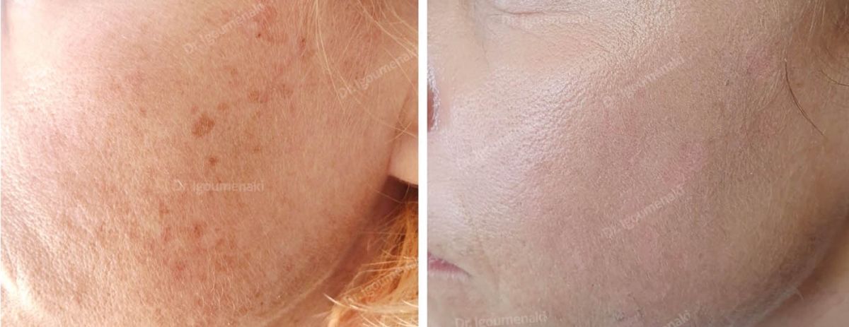 Rimozione macchie o lentigo