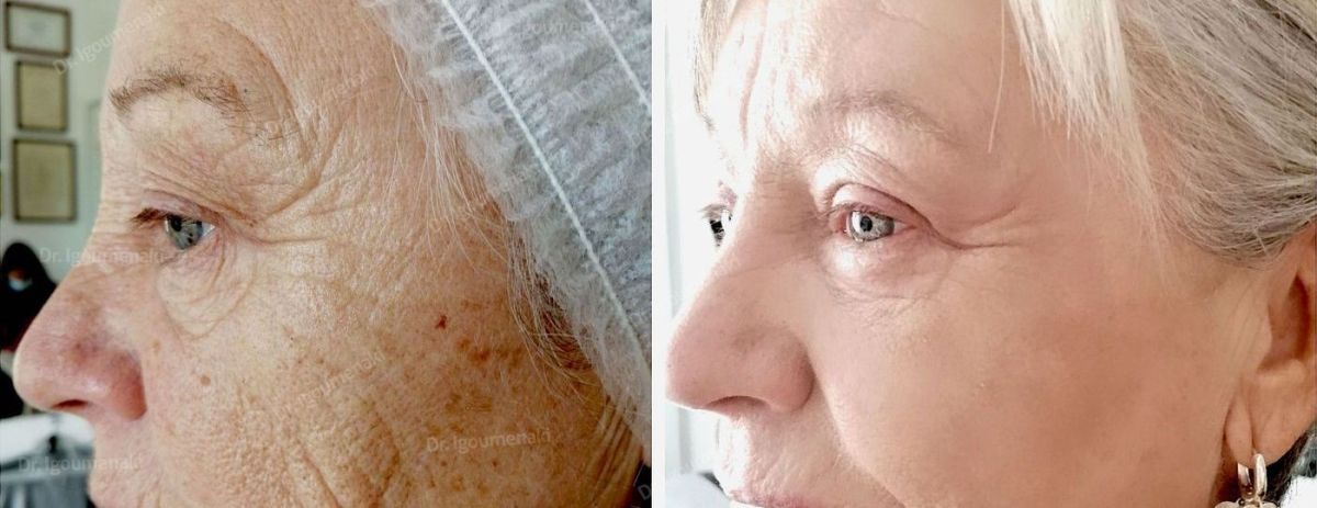 rimozione rughe del naso