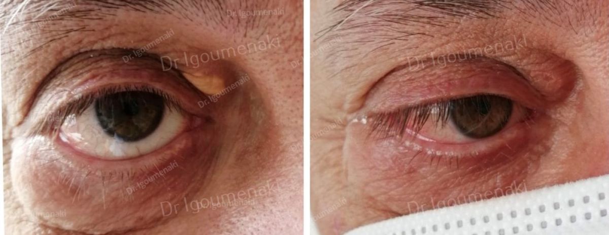 Rimozione xantelasmi