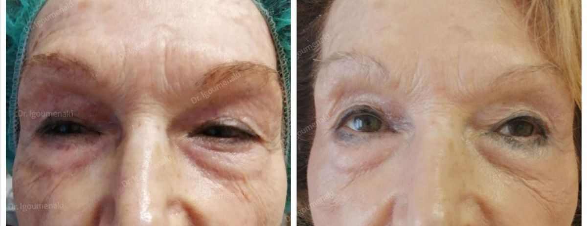 Blefaroplastica superiore non chirurgica