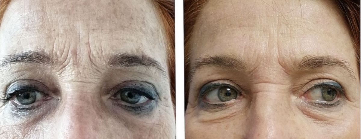 rimozione rughe frontali