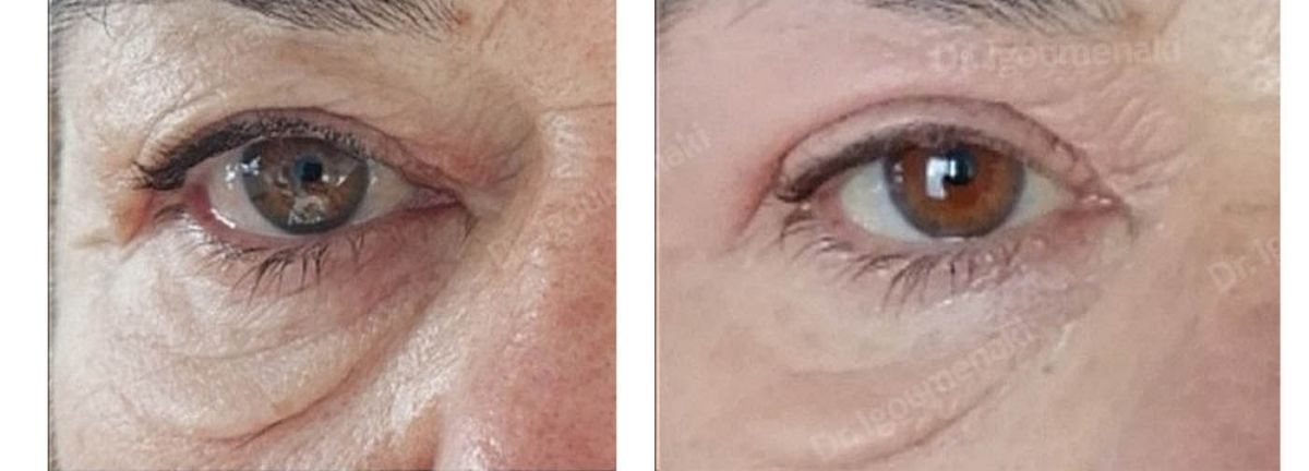 Blefaroplastica inferiore non chirurgica