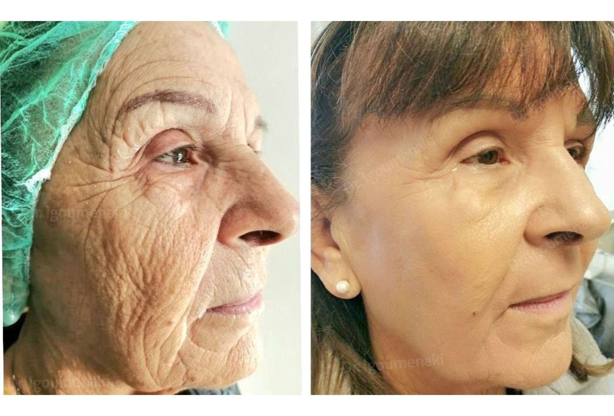 rimozione rughe dal volto