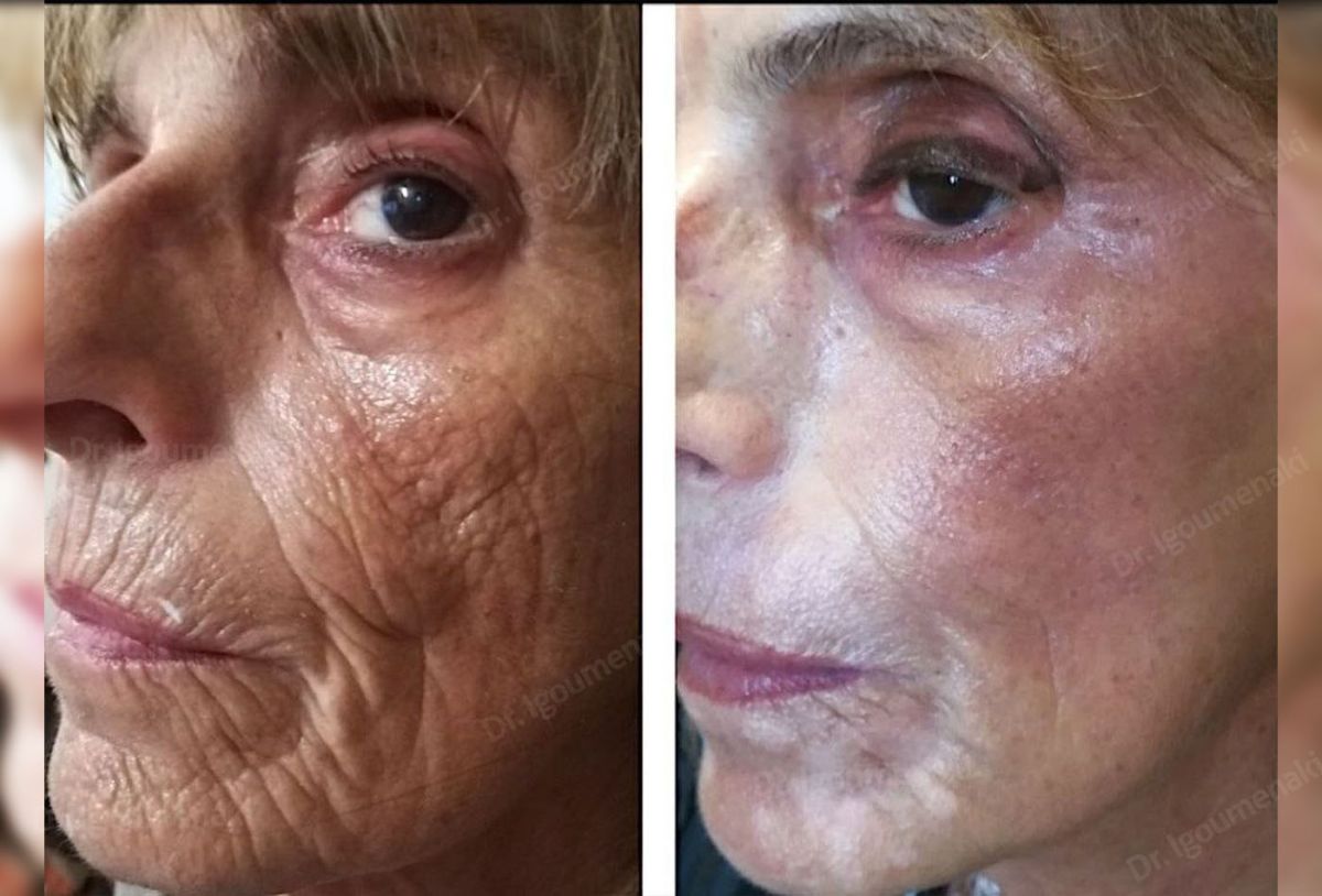 rimozione rughe dal volto